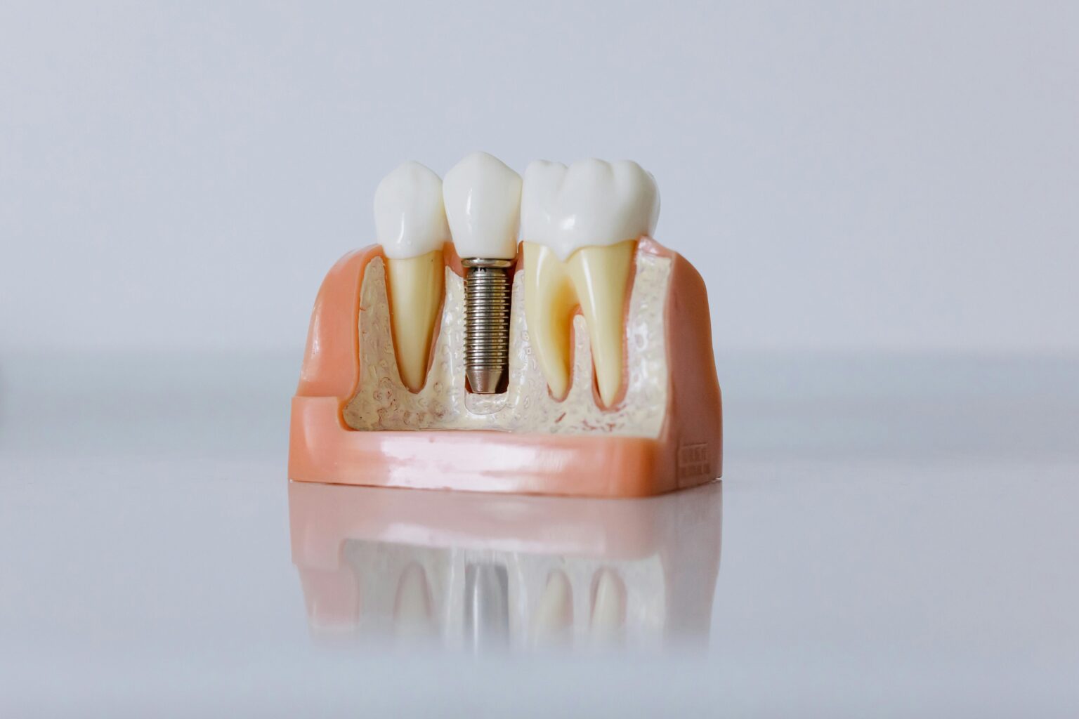Why Dental Implants Have Changed Modern Tooth Replacement
